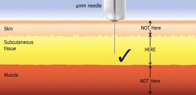 FIT Needle Length- 1
