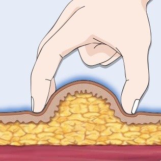 FIT Needle Length- 5