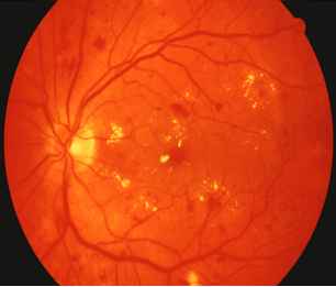 Retinopathy