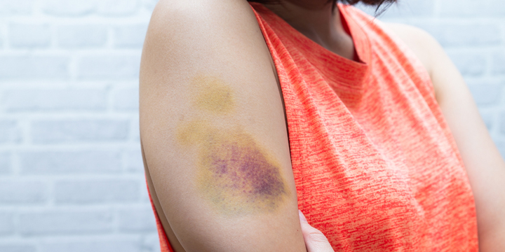 Bruise on woman arm. Injection bruises. Doctor and patient.
