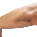 Acanthosis nigricans: causes, symptoms and treatments you should know about